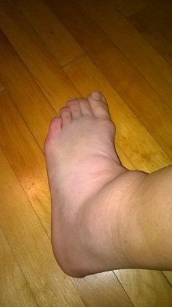 ankle_sprain.jpg